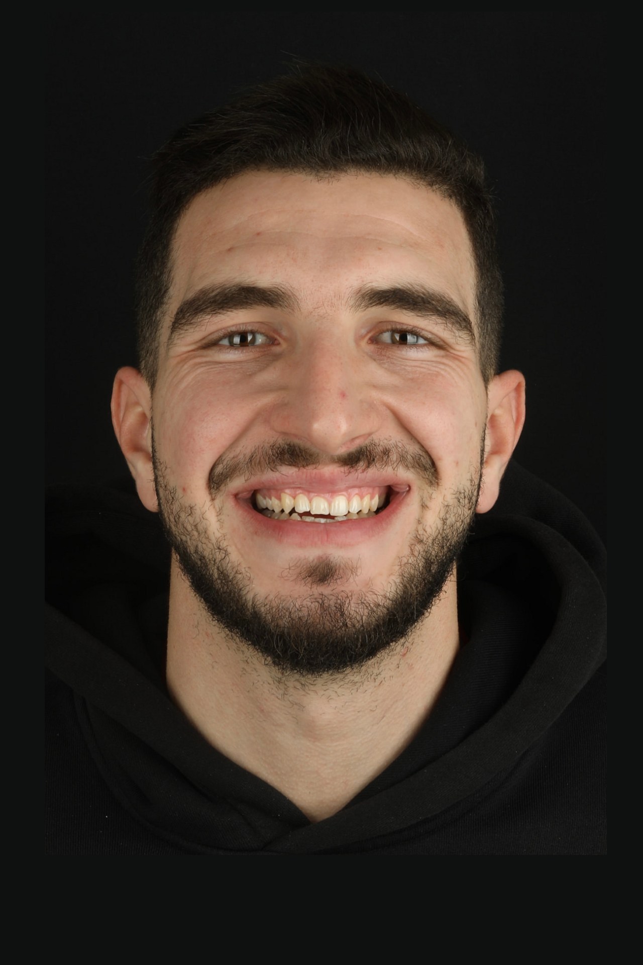Transformation esthétique d’un sourire, avant