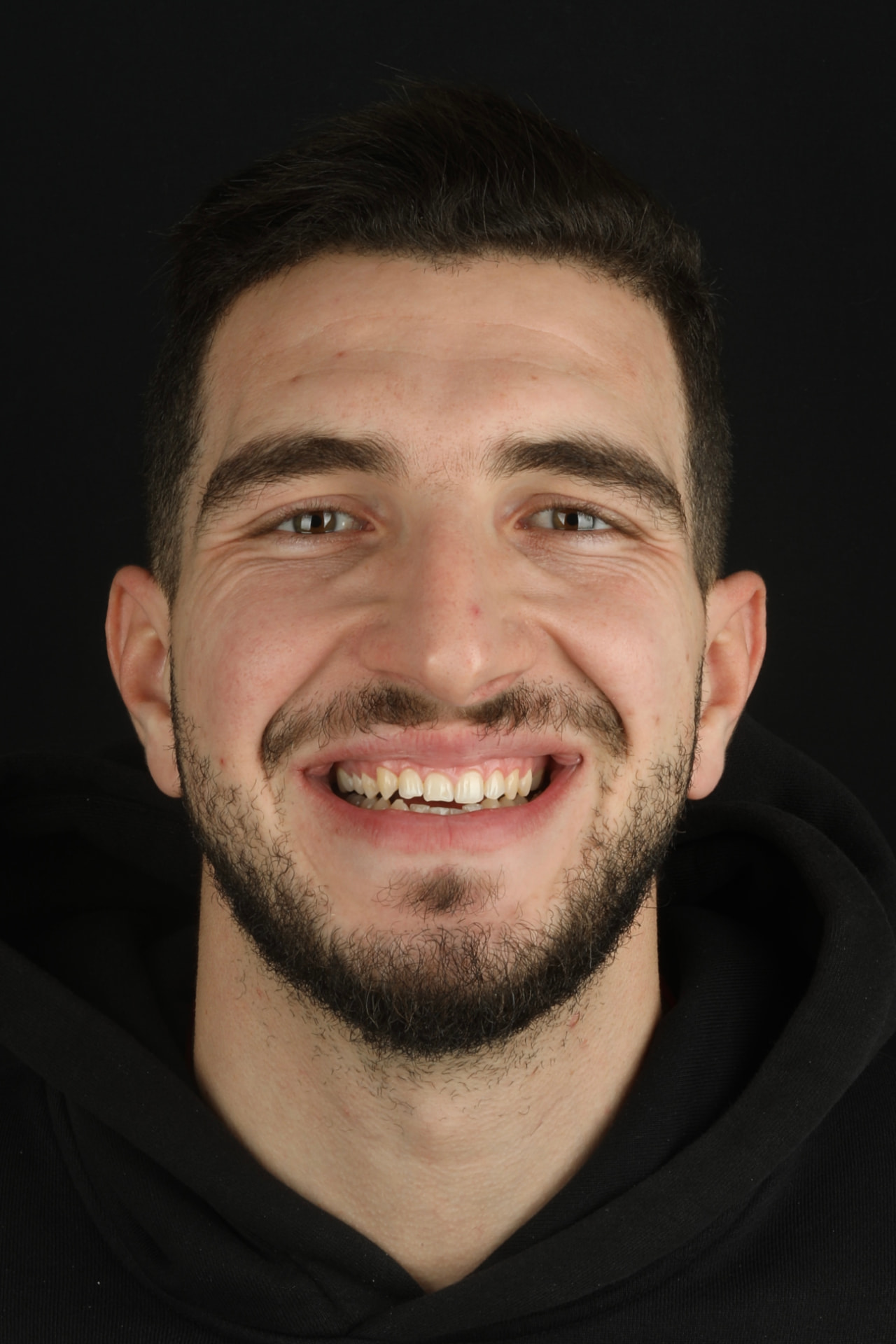 Portrait d'un patient avant réhabilitation du sourire