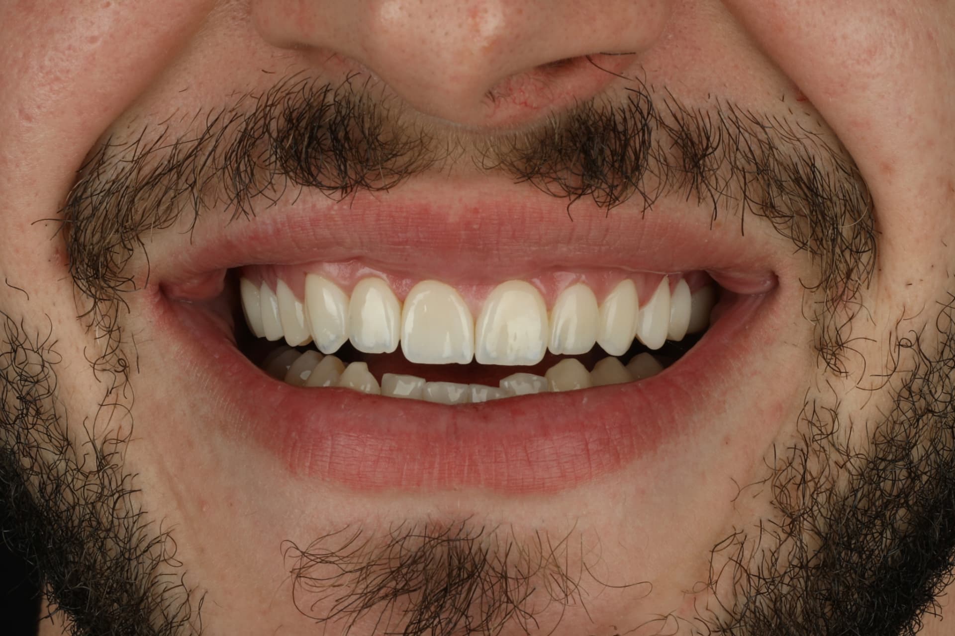 Sourire après la pose de facettes céramiques