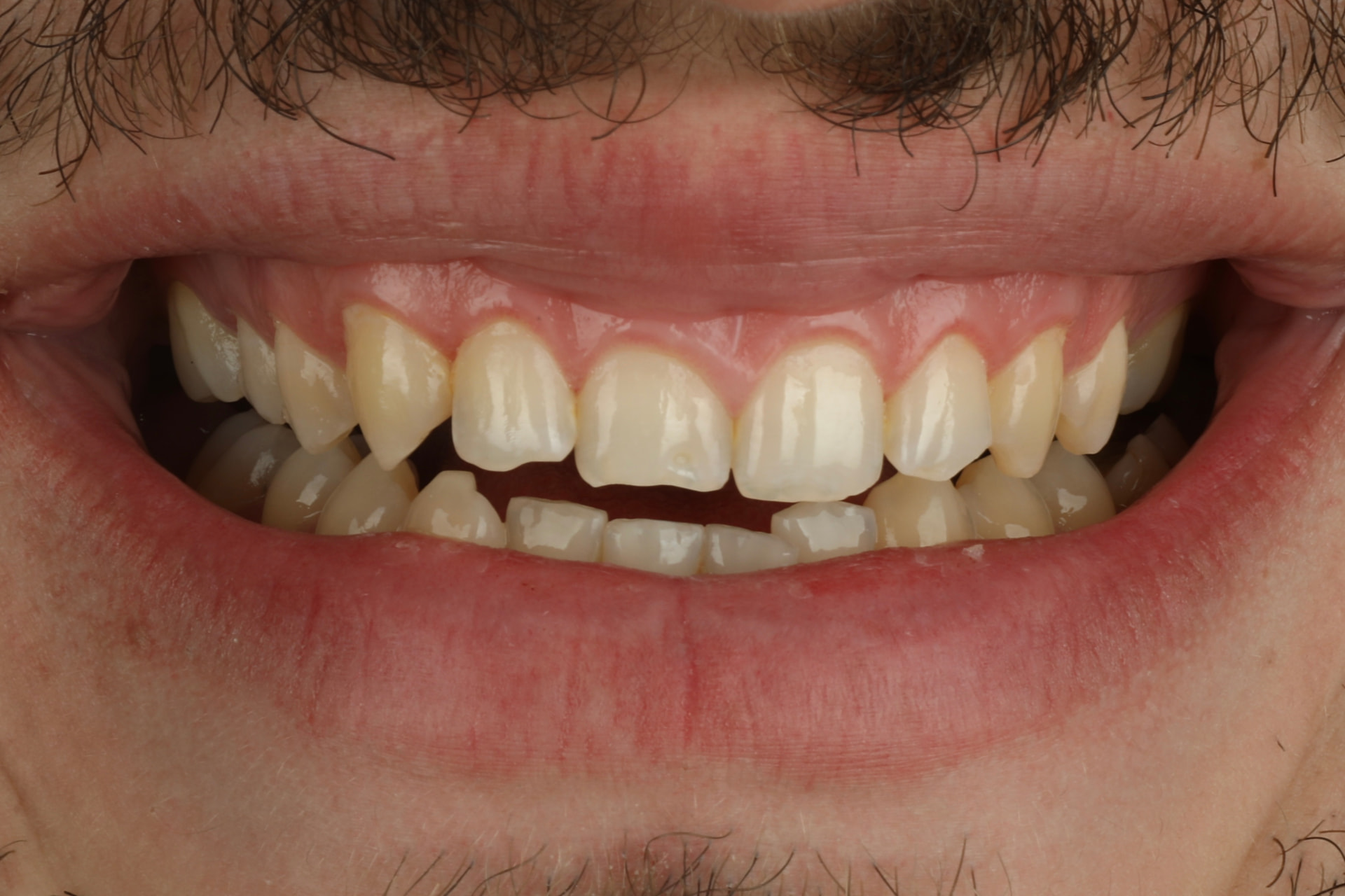 Sourire avant la pose de facettes céramiques
