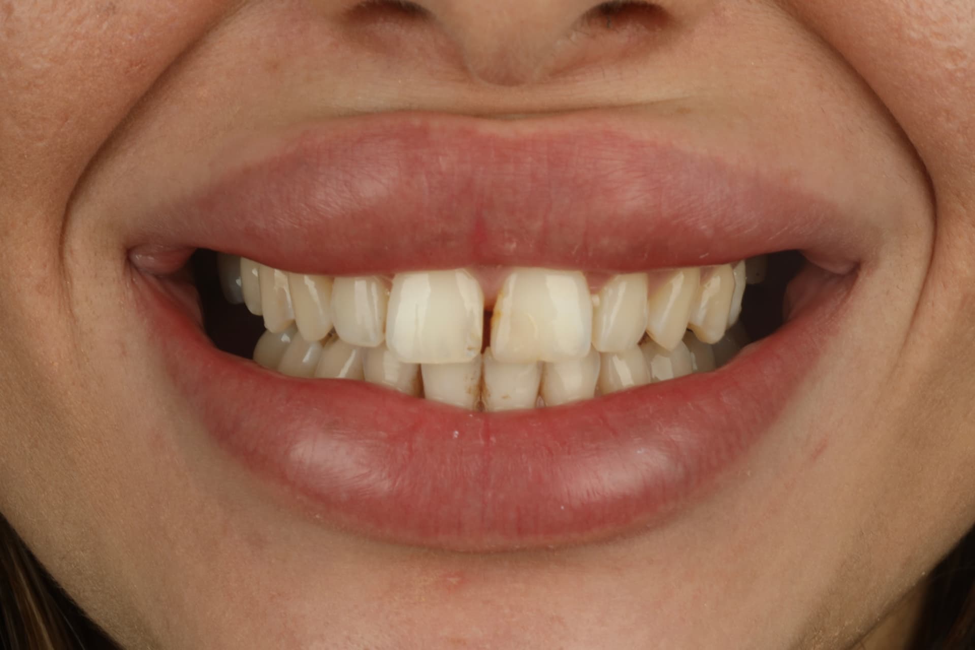 Sourire avant harmonisation esthétique
