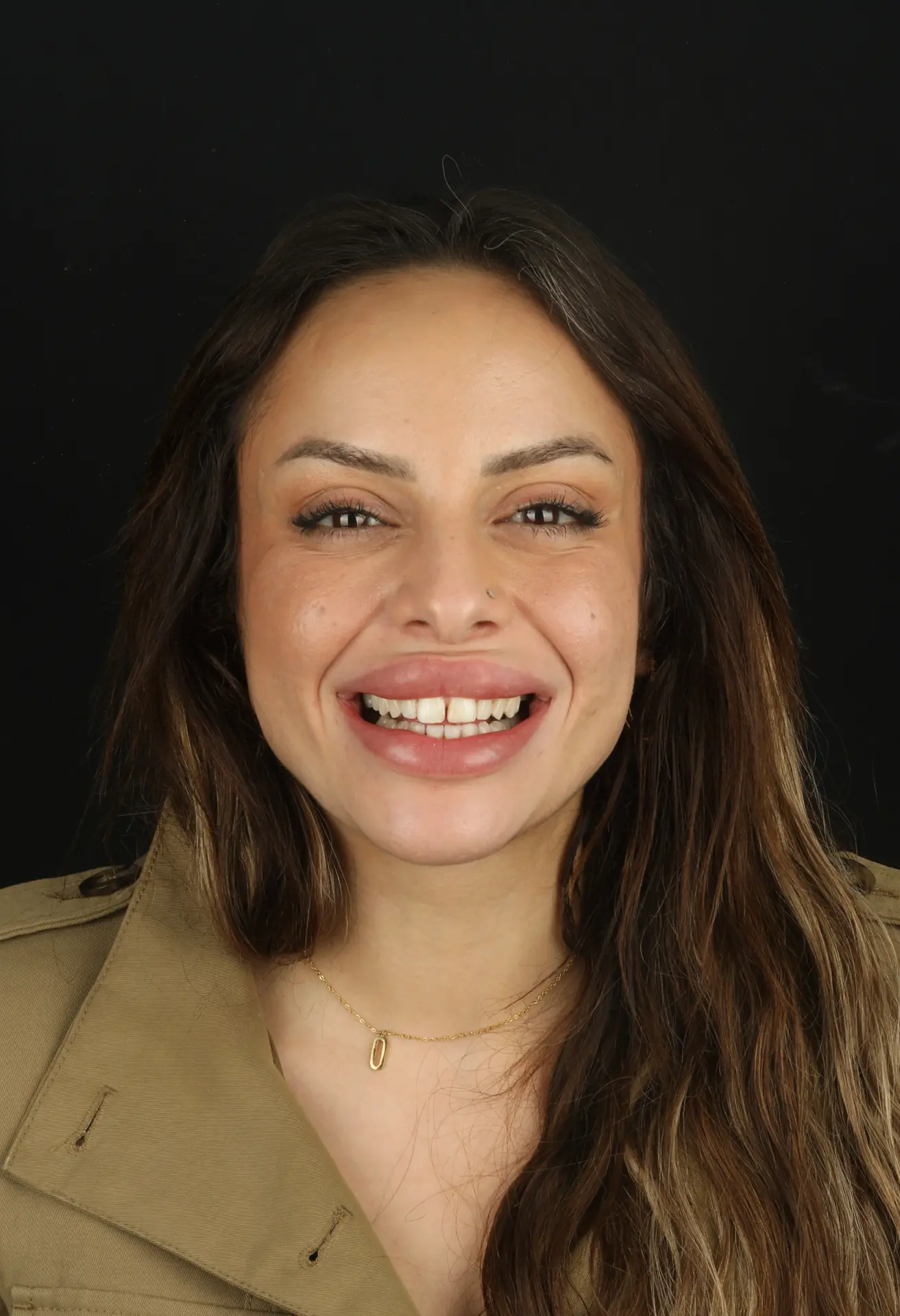 Harmonisation du sourire d’une patiente, avant